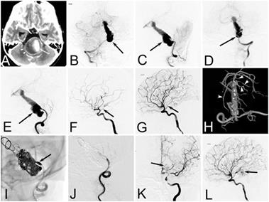 Treatment for Spontaneous Intracranial Dissecting Aneurysms in Childhood: A Retrospective Study of 26 Cases